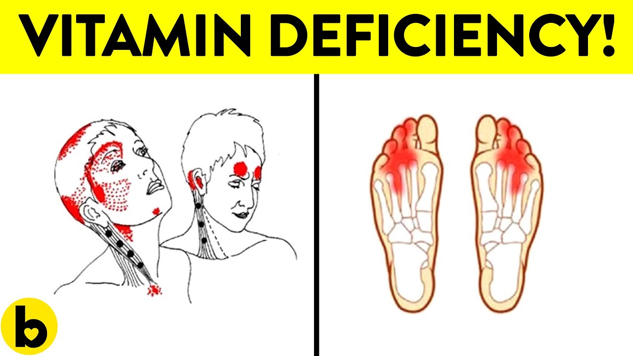 5 Warning Signs of Vitamin B12 Deficiency You Should Never Ignore